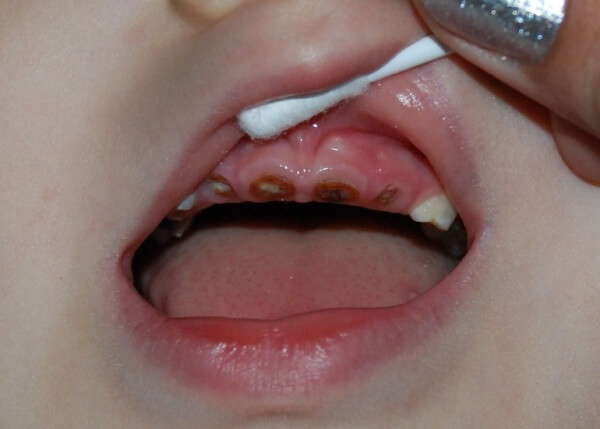 почему зубы становятся плохими у ребенка