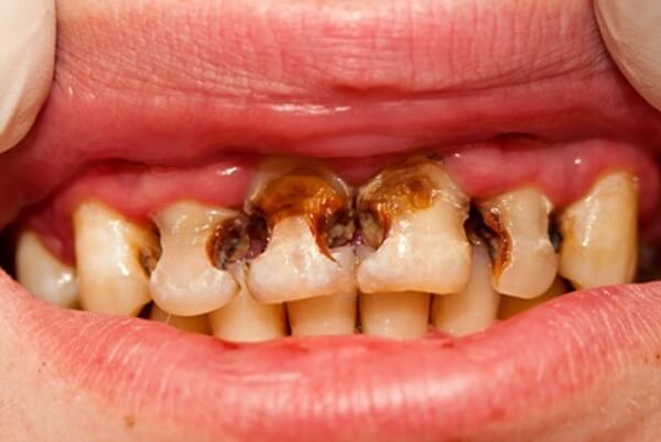 почему зубы становятся плохими у мужчины