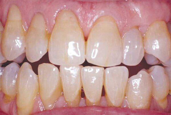 разновидности чувствительности зубов