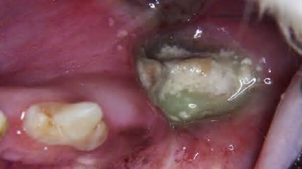 Лечение остеомиелита челюсти в домашних условиях thumbnail