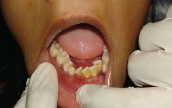 Лечение остеомиелита зуба народными средствами thumbnail