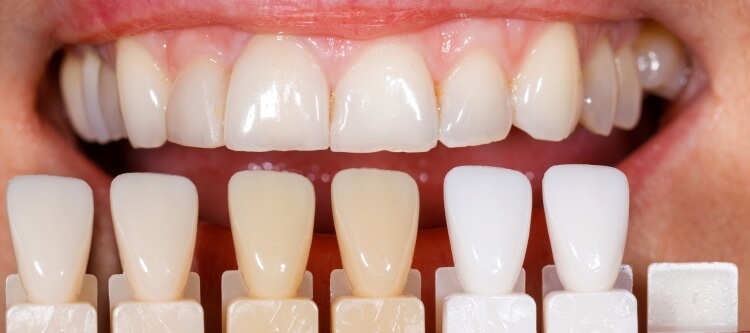 виниры в стоматологии интервью у дантиста