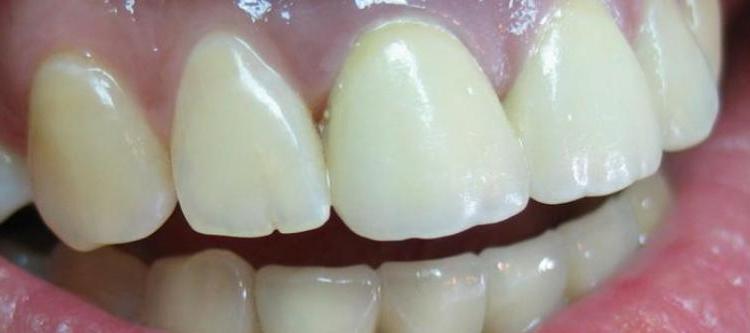 металлокерамические коронки устанавливаемые на передние зубы