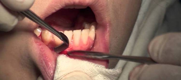 операция вестибулопластики нижней челюсти