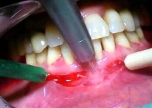 Вестибулопластика нижней челюсти фотографии отек после операции thumbnail