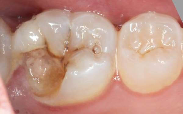 Скол жевательной поверхности заднего зуба