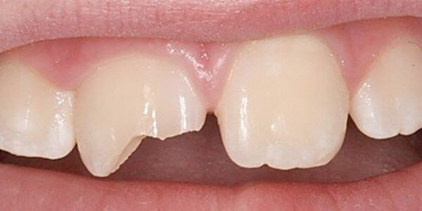 Разновидности сколов передних зубов