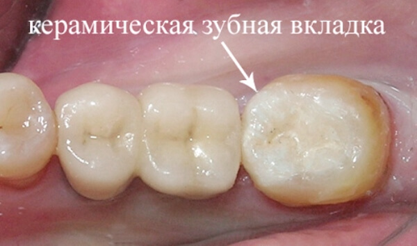 Как восстановить поверхность коренного зуба