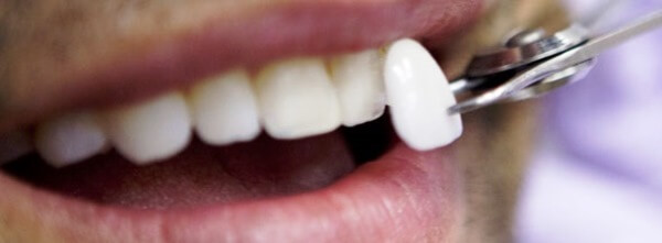 Методы восстановления поверхности переднего зуба