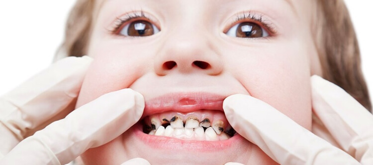 Принципы лечения кариеса молочных зубов