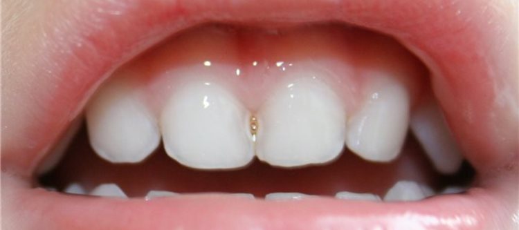 Лечение дырок между зубами thumbnail