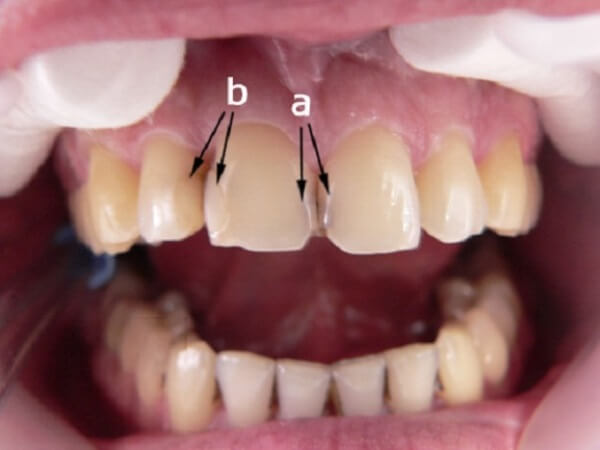 Особенности локализации кариеса между передними зубами