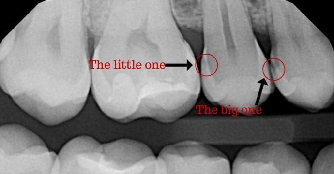 Как виден кариес между передними зубами на рентгеновском снимке