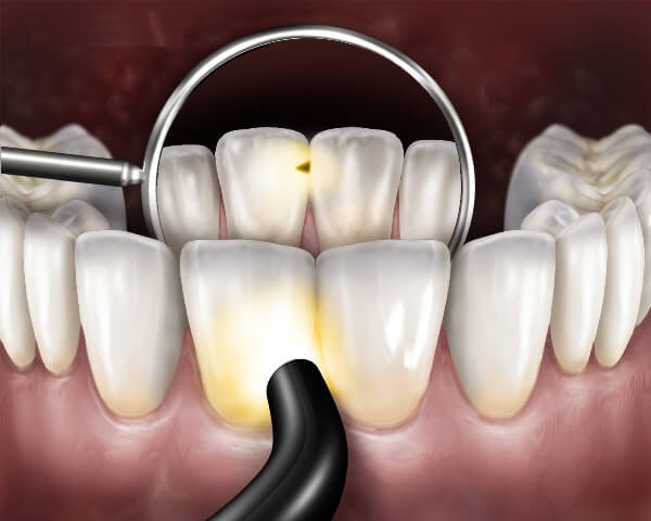 Как диагностировать кариес между передними зубами