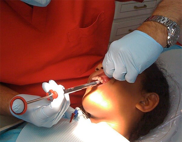 Проведение анестезии при лечении глубокого кариеса