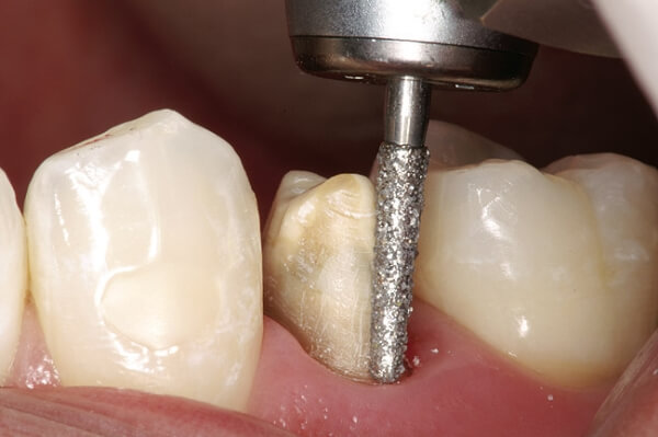 Как проводится обточка зуба под металлопластмассовую коронку