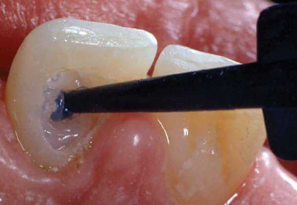 Процедура внутреннего отбеливания зубов системой Opalescence