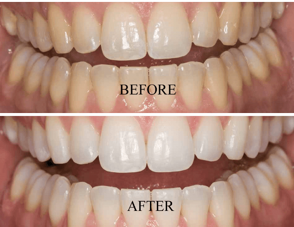 До и после отбеливания зубов системой Opalescence