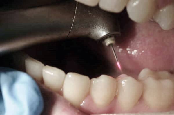 Плюсы и минусы лазерной стоматологической бормашины