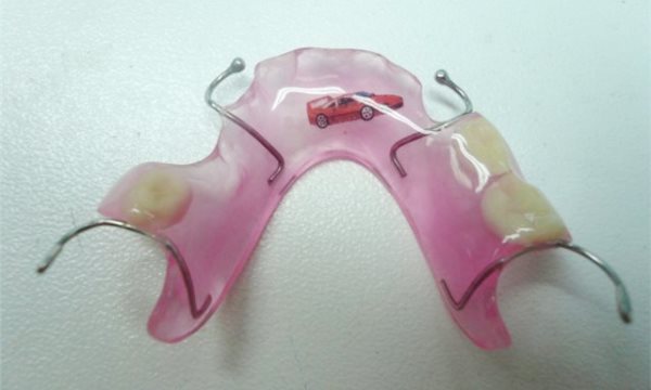 Пластинчатый протез для молочных зубов