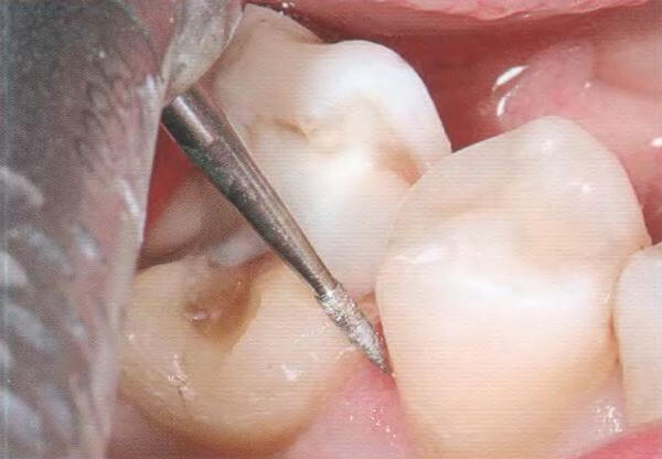 Этапы процедуры шлифовки зубов
