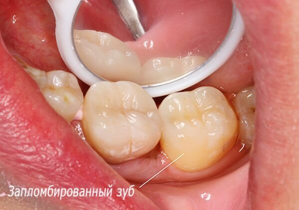 Болит неправильно запломбированный зуб при нажатии на него