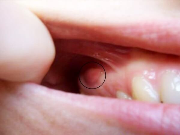 Почему болит леченый зуб особенно больно надкусывать thumbnail
