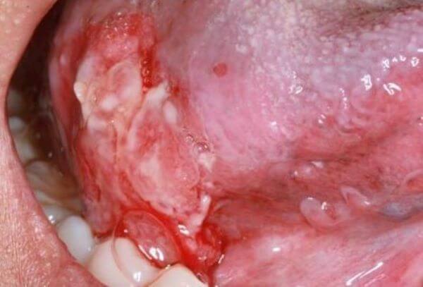 От чего зависит эффективность лечения рака полости рта