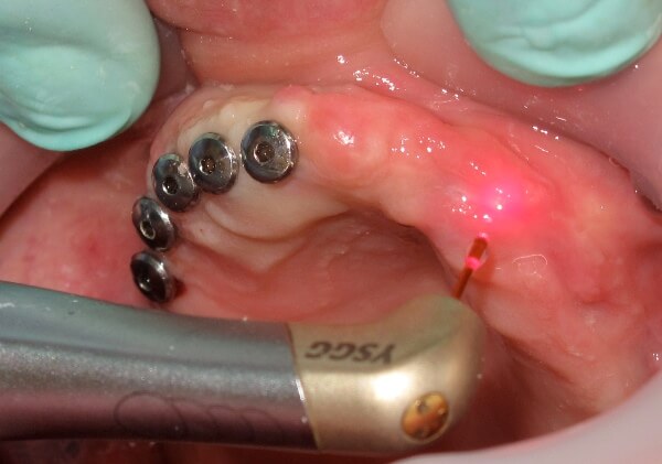 Что такое  лазерная имплантация зубов