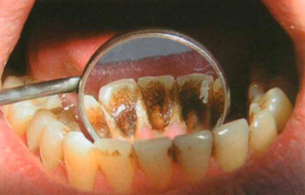 Признаки химического некроза зубов