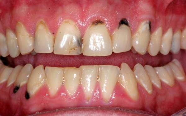 Кислотный некроз зубов лечение thumbnail