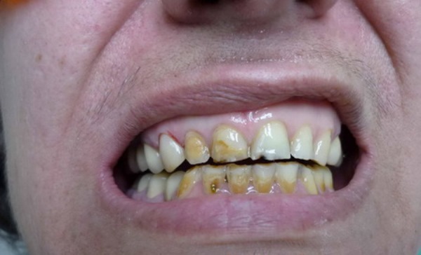 Особенности компьютерного некроза зубов