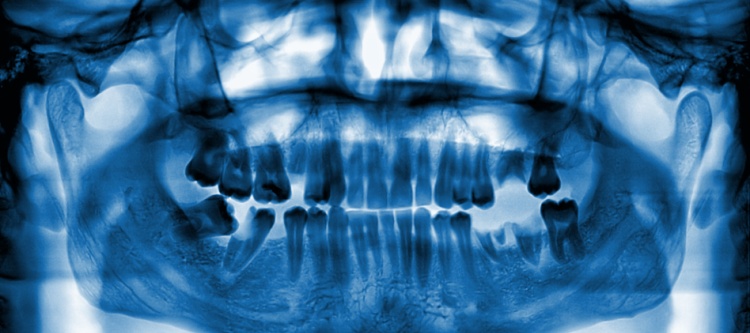Можно ли делать при беременности панорамный снимок зубов thumbnail