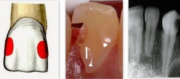 I класс по блеку лечение зубов thumbnail
