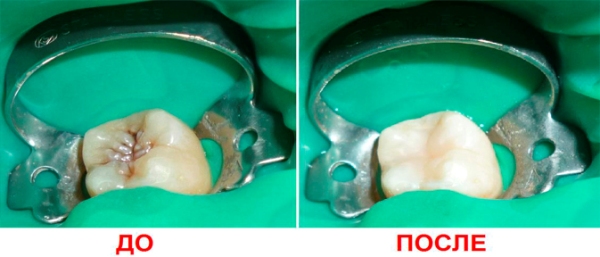 Лечение зубов icon до и после thumbnail