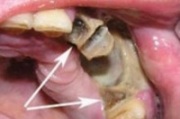 Изображение - Смещение челюстного сустава симптомы Osteomielit-verkhnei-cheliusti