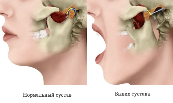 Подвывих челюсти что делать