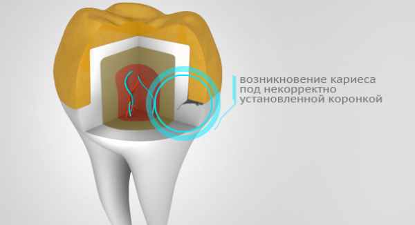 Болят зубы после обточки под коронки что делать