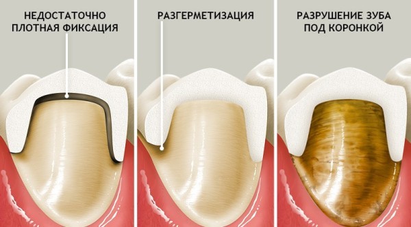 Что делать если под металлокерамикой болит зуб thumbnail