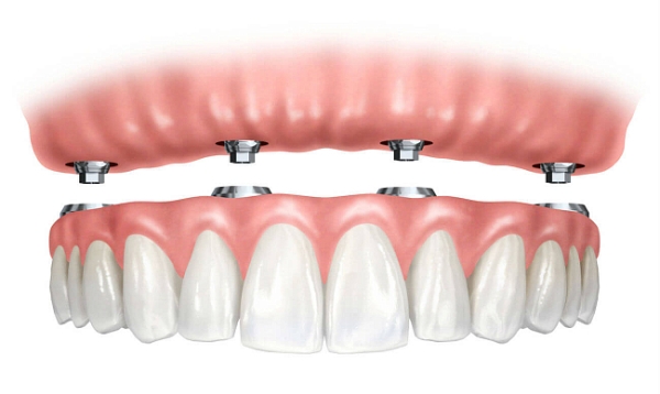 Показания к установке условно съемного протеза на опорных зубах