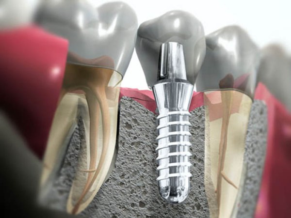 Плюсы и минусы экспресс имплантации зубов