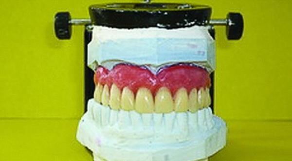 Как проводится изготовление съемных зубных протезов