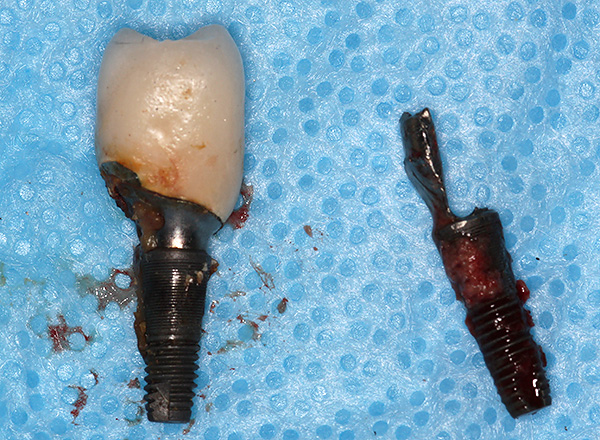 Причины отторжения импланта зуба и его удаление