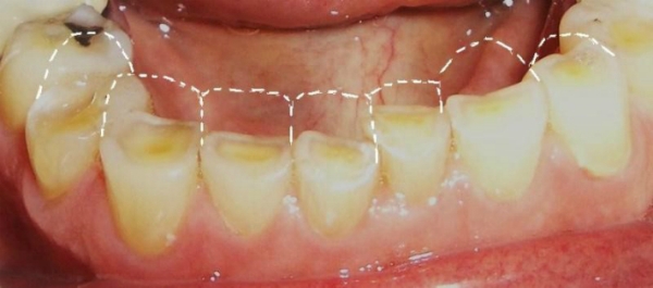 Современные методы лечения стираемости зубов thumbnail
