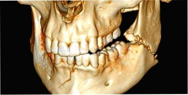 Остеосинтез перелома нижней челюсти операция