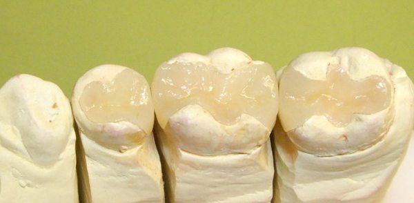 Восстановление жевательного зуба керамической вкладкой