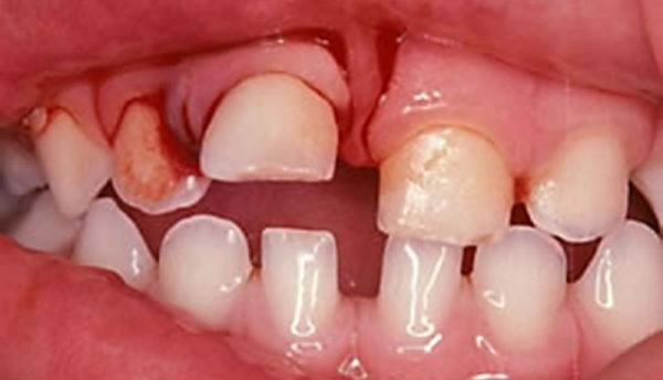 Репозиция зуба при неполном вывихе thumbnail