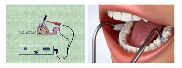 Электрофорез в стоматологии противопоказания thumbnail