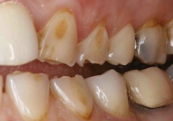 Тактика лечения эрозии эмали зубов