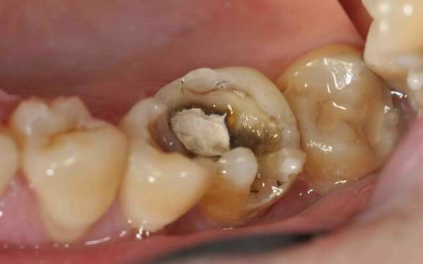 Классификация гнойного пульпита зуба